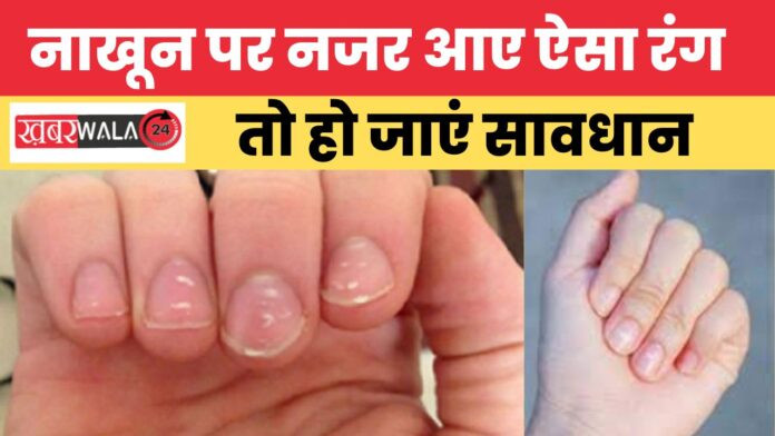 Nail Discoloration