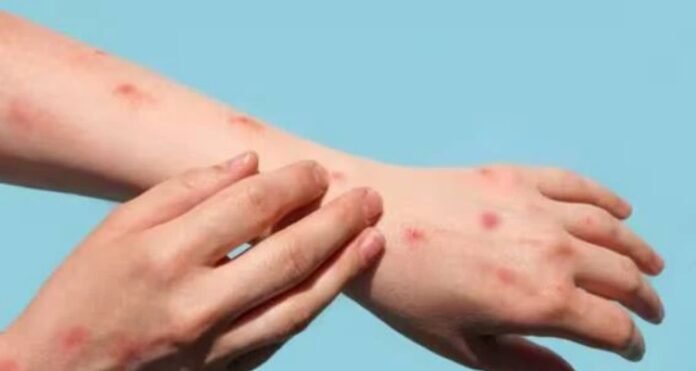 Monkeypox Virus Vaccine