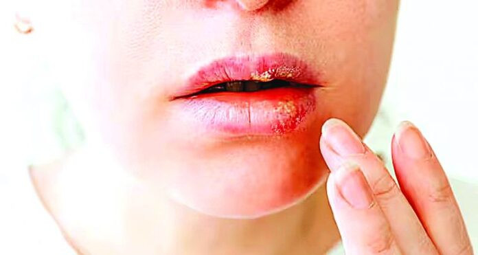Deficiency Causes Dry Lips