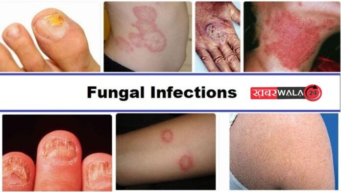 Fungal Infection