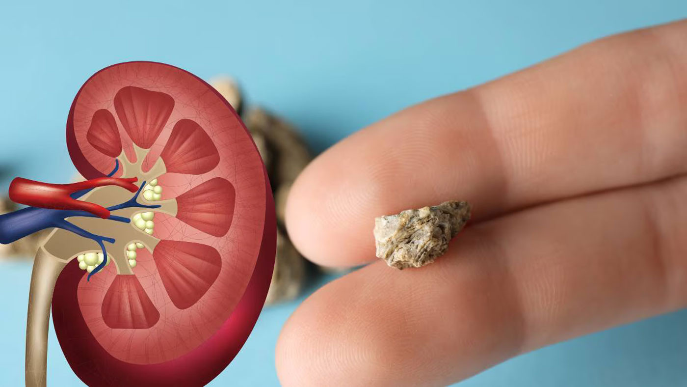 Kidney की बीमारियों के संकेत पर रहे गंभीर, जानें कैसे करें पहचान? 1 Kidney stones